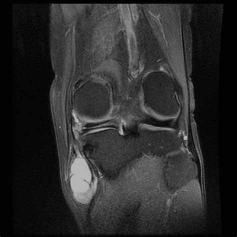 Pin on Knee MRI & XR Images