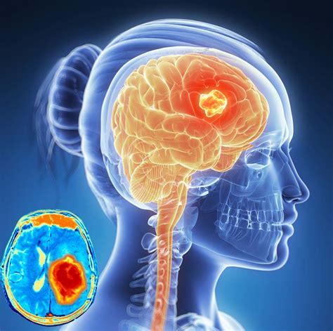 Brain cancer : FLASH radiotherapy dramatically reduces the adverse ...