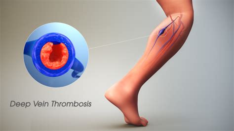 Deep Vein Thrombosis - Scientific Animations