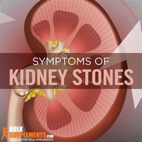 Kidney Stones: Symptoms, Causes & Treatment