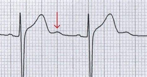 U Wave • LITFL Medical Blog • ECG Library Basics