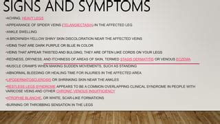 Varicose vein | PPT