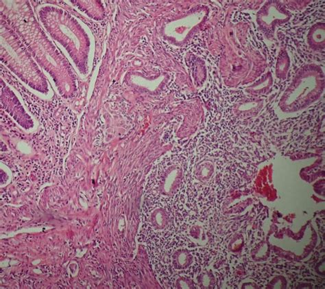 (a) Tomography revealing a cecum mass with complete bowel obstruction ...