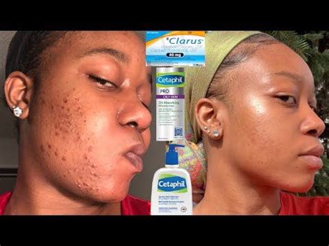 How I cleared my acne - YouTube in 2021 | Skin care pimples, Cetaphil acne, Clear skin routine