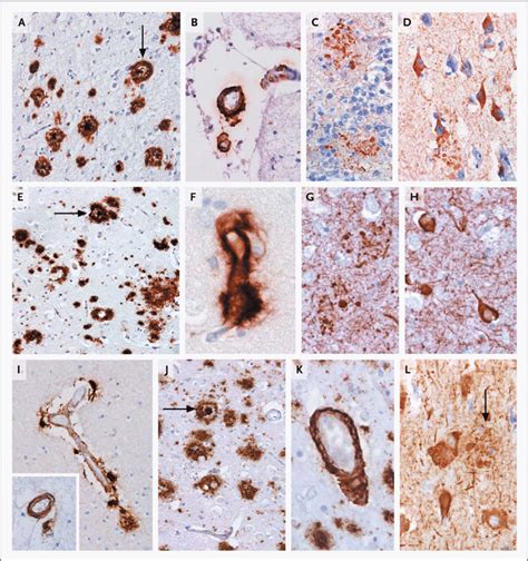 Pathological Hallmarks in Carriers of TREM2 Variants. Shown are... | Download Scientific Diagram