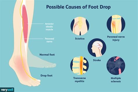 Exercices de physiothérapie pour le pied tombant