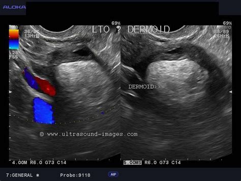 Ultrasound image gallery | Dermoid cyst, Ultrasound, Ovaries