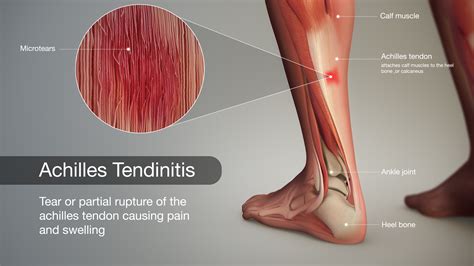 Achilles Tendon Rupture