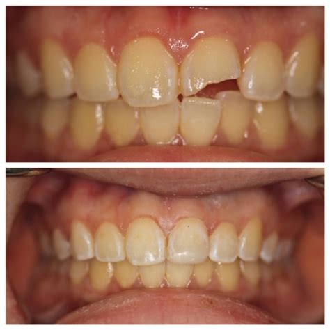 Male - Before and After - Chipped Tooth - 212 Smiling