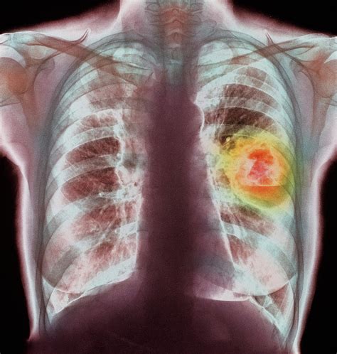 Coloured X-ray Showing Lung Cancer Photograph by Simon Fraser/science Photo Library - Pixels