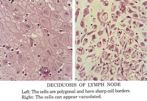 Pathology Outlines - Decidual reaction / ectopic decidua