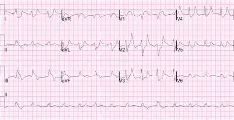 Dr. Smith's ECG Blog: "Steve, what do you think of this ECG in this Cardiac Arrest Patient?"