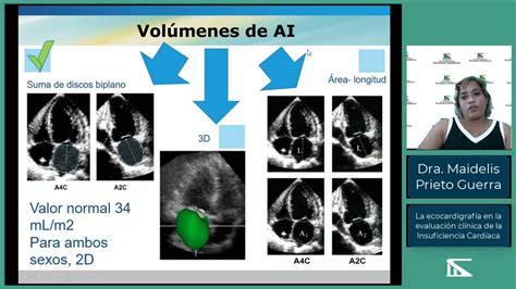 Ecocardiograma De Insuficiencia Cardiaca