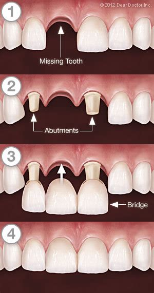 Fixed Bridges | Bangor ME | Dr. Michele Spekhardt