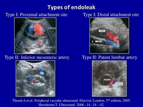 Doppler ultrasound of lower limb arteries