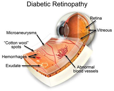 Diabetic Retinopathy: The Signs, Symptoms, and Solutions | Ocular Prosthetics, Inc.