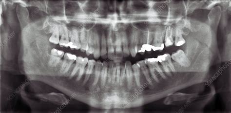 panoramic x ray anatomy