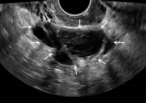 Cureus | A Missed Diagnosis of Ovarian Torsion in a Patient with ...