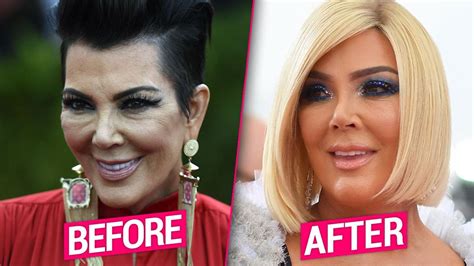 Kris Jenner's Plastic Surgery Makeover Exposed By Top Docs