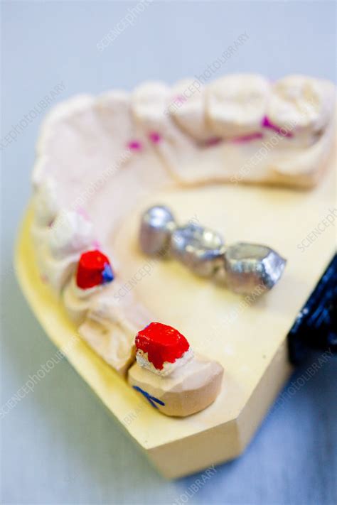 Dental prosthesis - Stock Image - C032/5495 - Science Photo Library