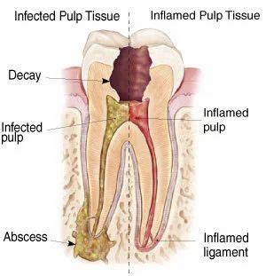 Root Canal Treatment Service in Ludhiana, Shimla Puri, by Balaji Dental ...