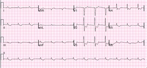 Dr. Smith's ECG Blog: Looks like a Posterior STEMI. Is it?
