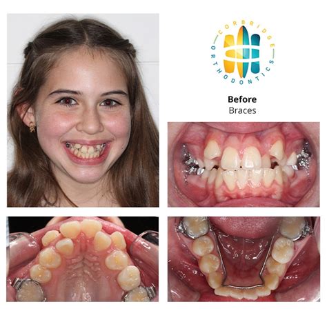 Before and After orthodontic treatment | Corbridge Orthodontics