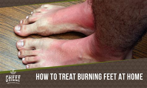 Home remedies for burning feet: 12 easy remidies - Cheef Botanicals