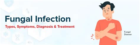 Fungal Infection: Types, Symptoms, Diagnosis And Treatment | Ganesh Diagnostic