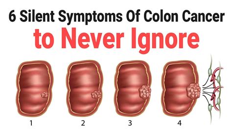 6 Silent Symptoms Of Colon Cancer to Never Ignore | Power of Positivity