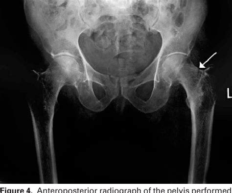 Figure 2 from Bilateral occult hip fracture. | Semantic Scholar