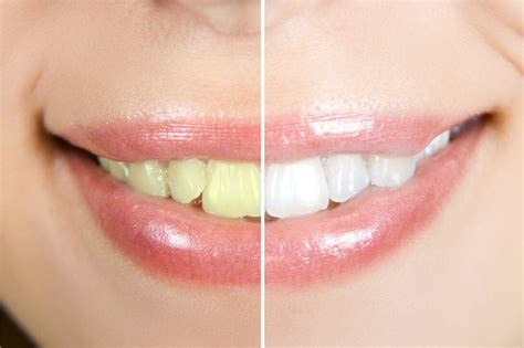 Cosmetic Dentistry Before And Afters (Amazing Smile Transformations)