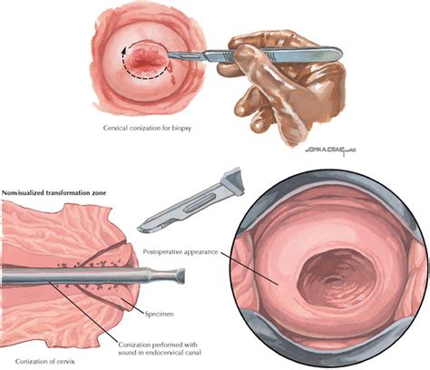 Cervical Conization (Cold Knife) | Obgyn Key