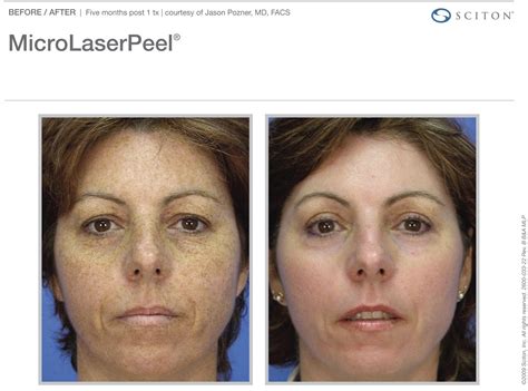 micro-laser-peel-before-after-8 | Robinson FPS