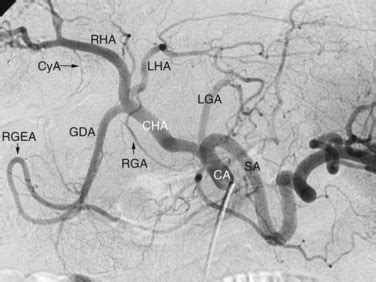 Celiac Artery Angiogram