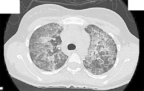 CT lung scan showing crazy paving pattern | Download Scientific Diagram