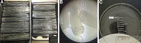 Nine Taenia saginata Inhabit the Intestine in a Patient - Clinical ...