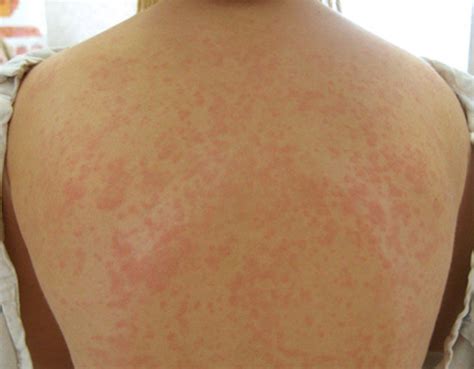 Maculopapular Rash - Pictures, Causes, Treatment, Diagnosis