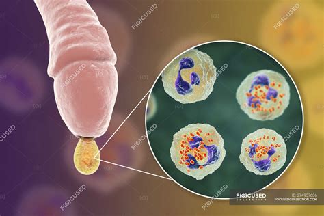 Neisseria Gonorrhoeae Disease