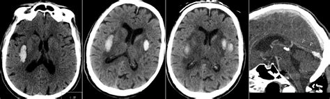 Radiology MRI: Deep Cerebral Venous Sinus Thrombosis with External Capsule Hemorrhage