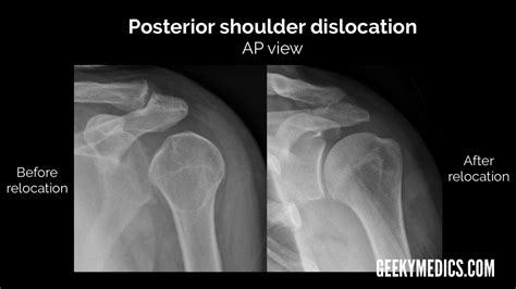 X Ray Normal Shoulder