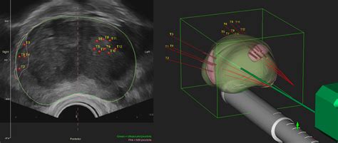 Robotic Biopsy | Buderim Prostate Clinic