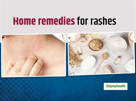 Want To Treat Rashes On Skin? Here Are 7 Effective Home Remedies To Get ...