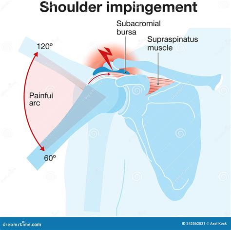 Shoulder Impingement Syndrome Royalty-Free Stock Photography ...