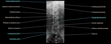 A Review on Reading Lumbar X-rays - Sports Medicine Review