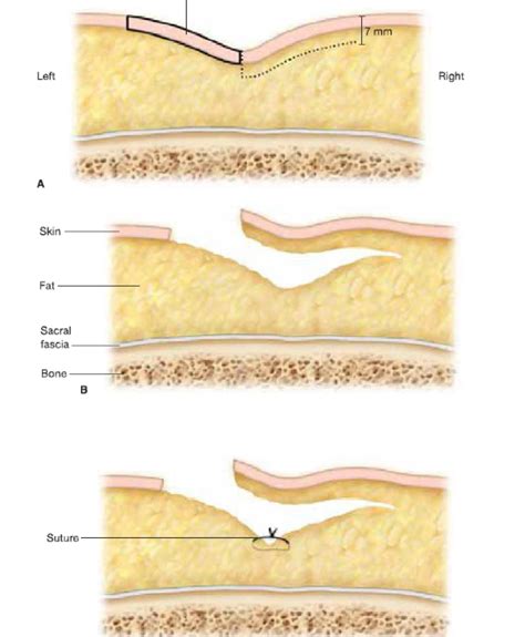 Pilonidal Sinus | Dr. Shashikant S Jadhav