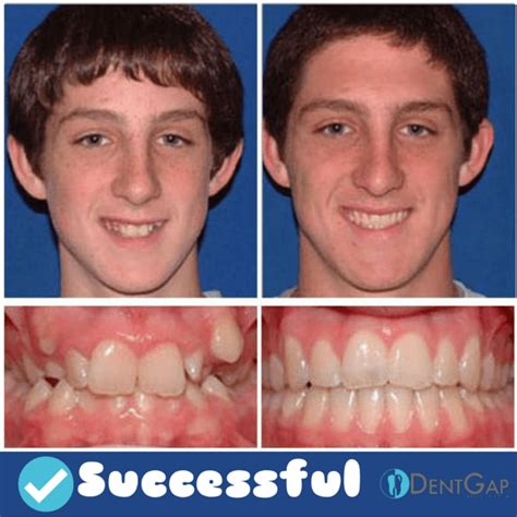 Braces Before and After - 5 FACTS You should know before getting braces, Images, for adults ...