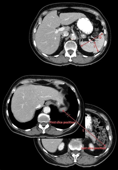 Estimate of spleen volume on CT or MRI, splenic index - calculator ...