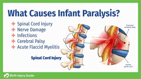 What Causes Infant Paralysis? - Birth Injury Guide