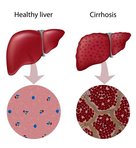 Cirrhosis of the Liver Podcast and Nursing Care Plan